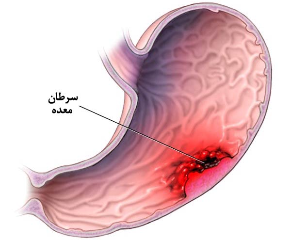 زخم معده باعث سرطان می‌شود؟